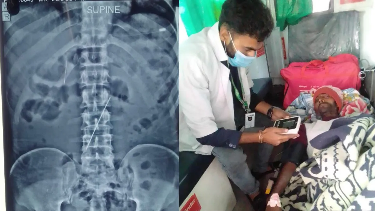 एक्स-रे में खुला रहस्य: पेट और सीने में दर्द से परेशान युवक के पेट में मिली तीन सुईं, हैरत में डॉक्टर 