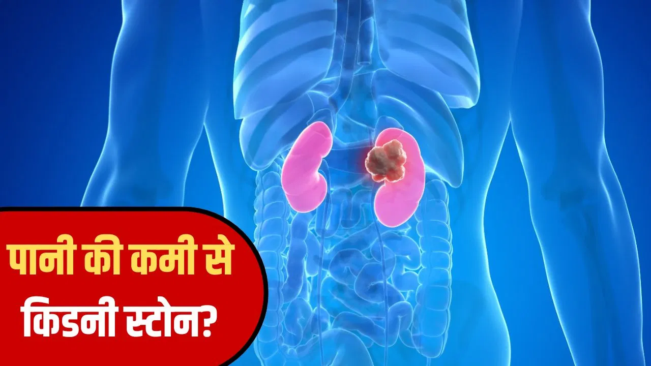 रोज़ पानी कम पीने की आदत बना सकती है आपको किडनी स्टोन का मरीज