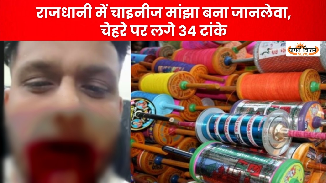 RAIPUR: मकर संक्रांति पर चाइनीज मांझे का कहर, युवक के चेहरे पर लगे 34 टांके