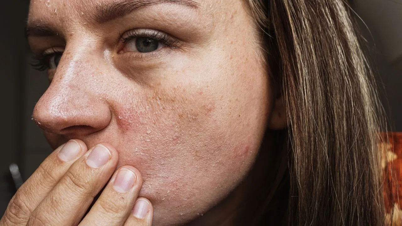 सर्दियों में स्किन ड्राइनेस दूर करने के लिए क्या करें? एक्सपर्ट से जानें