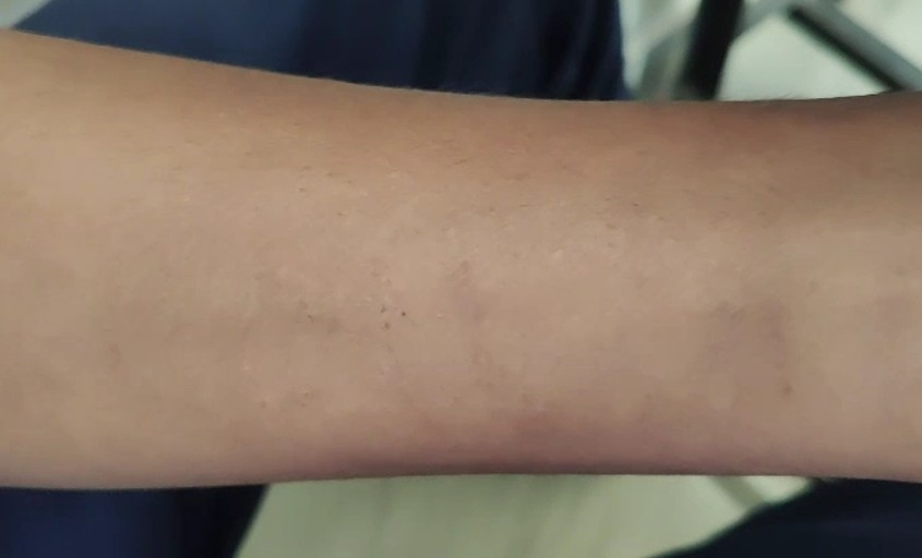 धमतरी: 35 बच्चों के हाथ पर एक जैसे जख्म, क्या है इसके पीछे की सच्चाई?