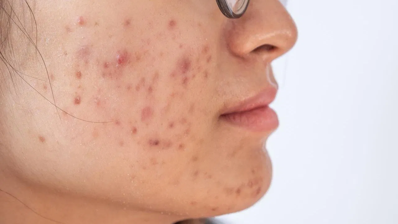 किन वजह से स्किन पर पिंपल्स बढ़ जाते हैं? कैसे बचें
