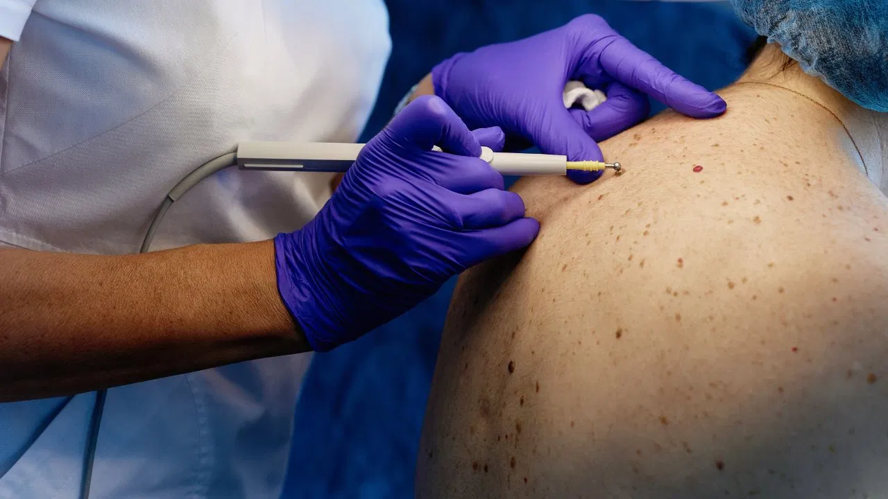 बार-बार स्किन पर इंफेक्शन होना किस बीमारी का संकेत है? जानिए कारण और बचाव