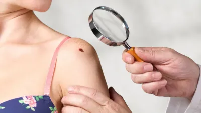 शरीर पर मौजूद तिल सुरक्षित है या सेहत के लिए खतरनाक? ऐसे करें पहचान