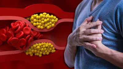 High Cholesterol क्यों बढ़ता है? रोज की ये गलत आदतें बना सकती हैं हार्ट डिजीज का कारण, जानें एक्सपर्ट की सलाह