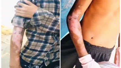 हॉस्टल की रसोई में बड़ा हादसा! गर्म दाल की चपेट में आए दो छात्र, परीक्षा भी छूटी; परिजनों ने उठाए व्यवस्था पर सवाल
