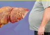 ग्लोबल लेवल पर तेजी से बढ़ रही लीवर की समस्या, लैंसेट रिपोर्ट का दावा- 2050 में हो जाएंगे 2 अरब लोग पीड़ित