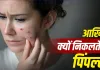 बारिश की उमस में क्यों बढ़ जाते हैं पिंपल्स? एक्सपर्ट ने बताया स्किन खराब होने का साइंस