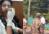 Balod Acid Attack: स्कार्फ ने बचाया युवती का चेहरा, दाहिनी आंख पर तेजाब का गंभीर असर; डॉक्टरों की निगरानी में इलाज