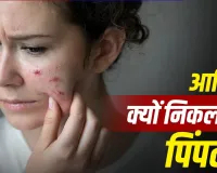 बारिश की उमस में क्यों बढ़ जाते हैं पिंपल्स? एक्सपर्ट ने बताया स्किन खराब होने का साइंस