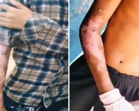 हॉस्टल की रसोई में बड़ा हादसा! गर्म दाल की चपेट में आए दो छात्र, परीक्षा भी छूटी; परिजनों ने उठाए व्यवस्था पर सवाल