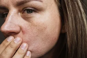 सर्दियों में स्किन ड्राइनेस दूर करने के लिए क्या करें? एक्सपर्ट से जानें