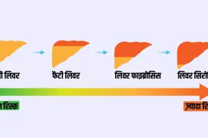 अल्ट्रासाउंड में फैटी लिवर ग्रेड-2 आने का क्या मतलब, ये कितना ख़तरनाक है?