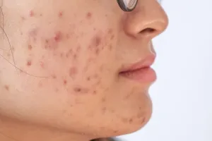 किन वजह से स्किन पर पिंपल्स बढ़ जाते हैं? कैसे बचें